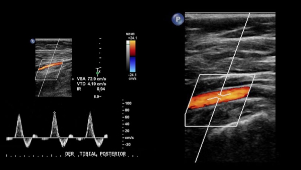 Ecografia Doppler vasculară